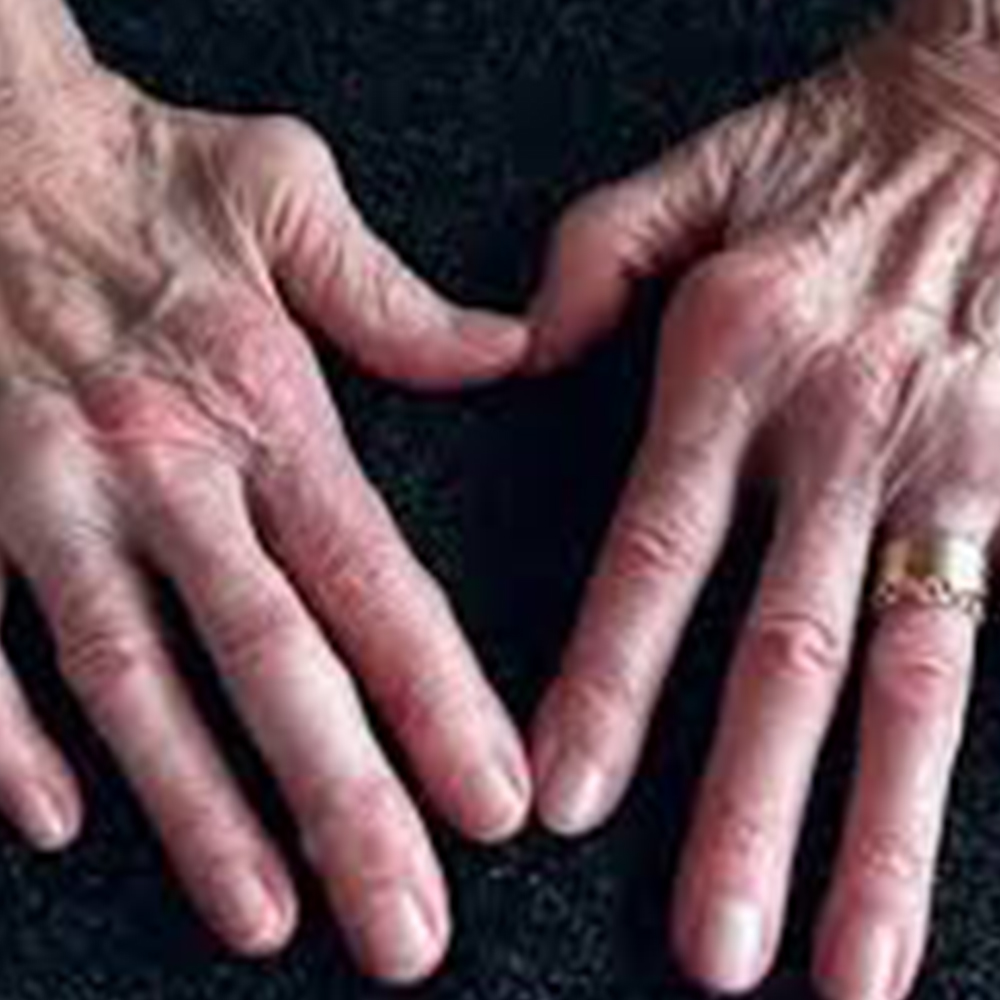 Rheumatoid Arthritis