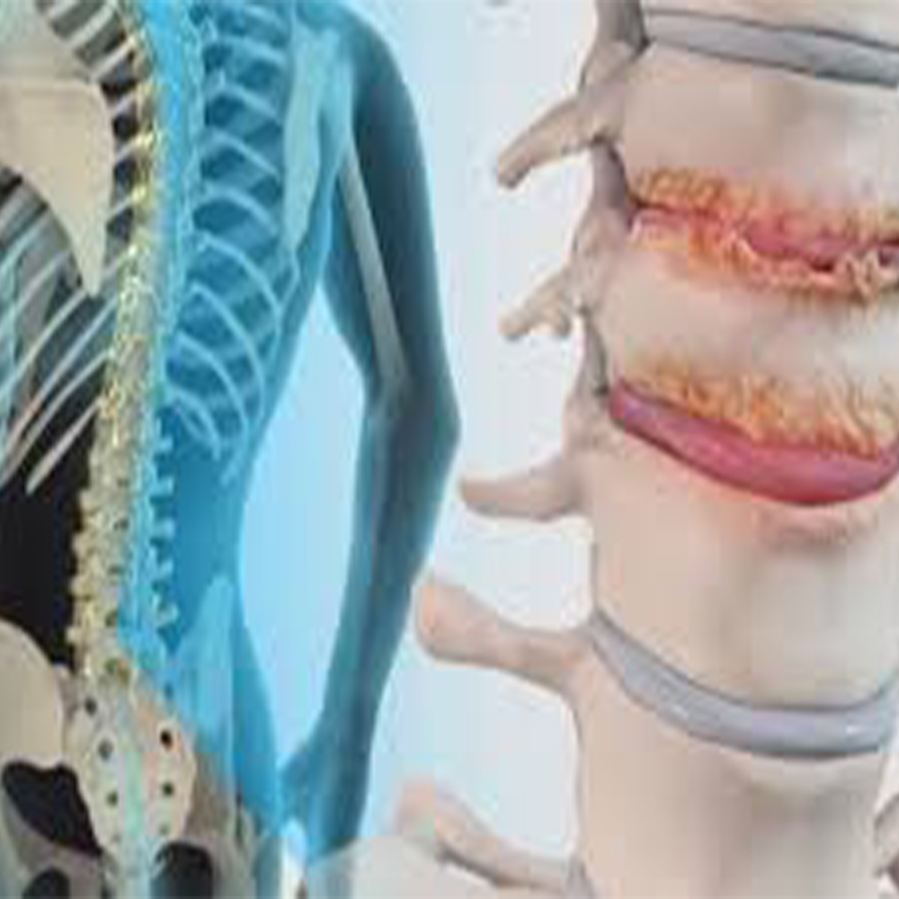 Spondylosis